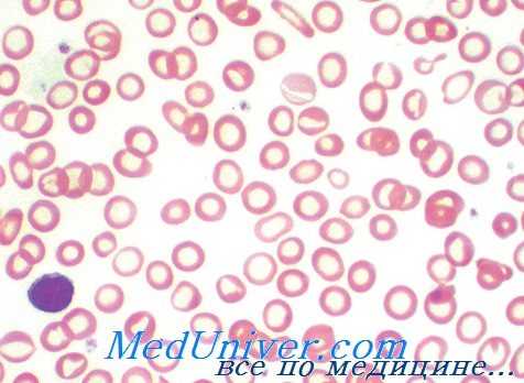 гипохромная анемия
