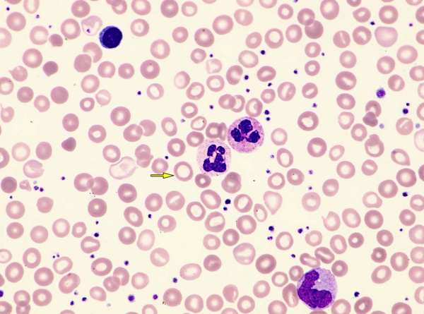 Железодефицитная анемия