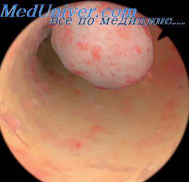 гистероскопия