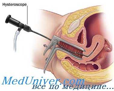 гистероскопия