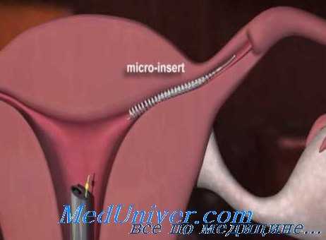 гистероскопическая стерилизация