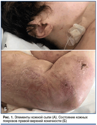 Рис. 1. Элементы кожной сыпи (А). Состояние кожных покровов правой верхней конечности (Б)