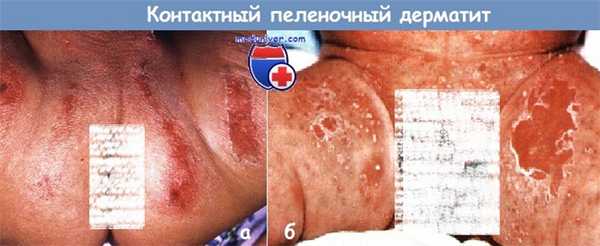 Пеленочный дерматит