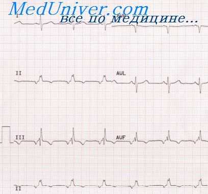 вариабельность ритма сердца