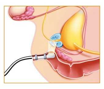 Гистологическое исследование материала. Биопсия предстательной железы.