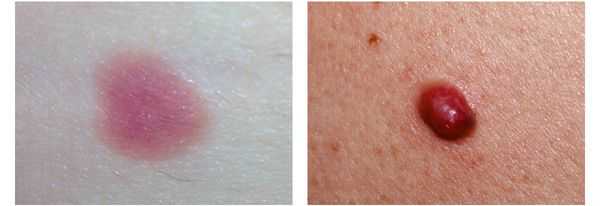 Беспигментная меланома