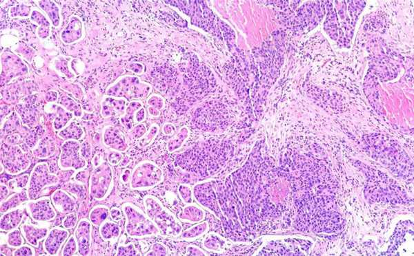 Инвазивная протоковая карцинома молочной железы