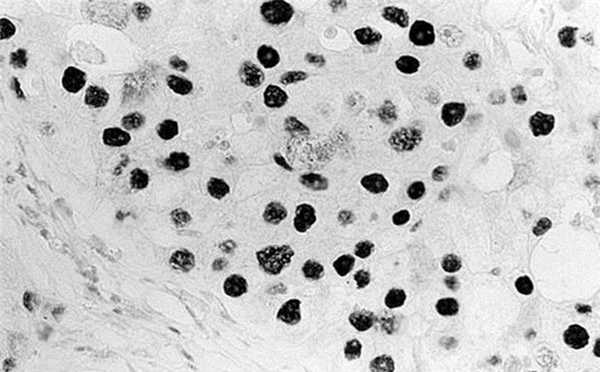 Иммуногистохимические особенности инвазивной апокринной карциномы молочной железы