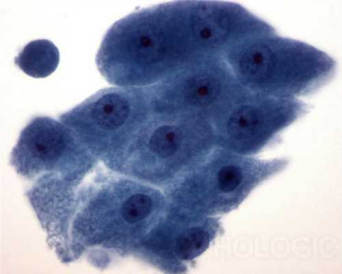 Клетки апокринного рака молочной железы. Зернистая цитоплазма, круглые ядра с выраженными ядрышками, четко определенные границы клеток