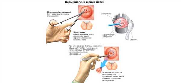 биопсия шейки.jpg