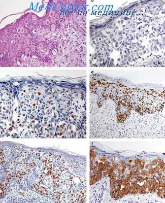 гистология болезни Педжета