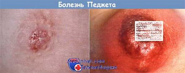 больная с болезнью Педжета