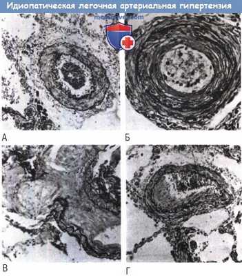 Гистология идиопатической легочной артериальной гипертензии (ИЛАГ)
