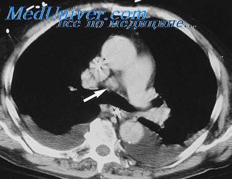 образование средостения