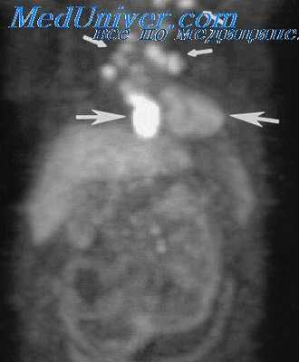образования средостения