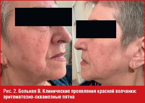 Больная В. Клинические проявления красной волчанки: эритематозно-сквамозные пятна
