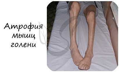 Атрофия мышц