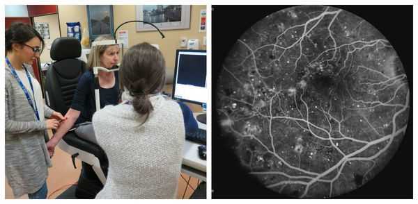 Флуоресцентная ангиография сетчатки