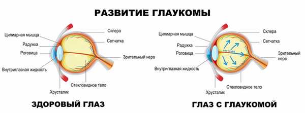 Развитие глаукомы.jpg