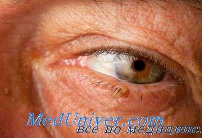 глаза при акромегалии