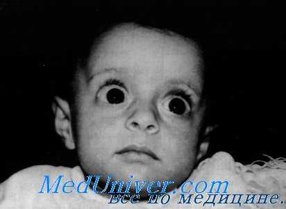 глаза при гиперальдостеронизме