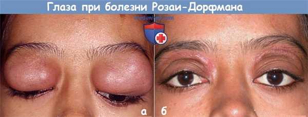 Глаза при болезни Розаи-Дорфмана