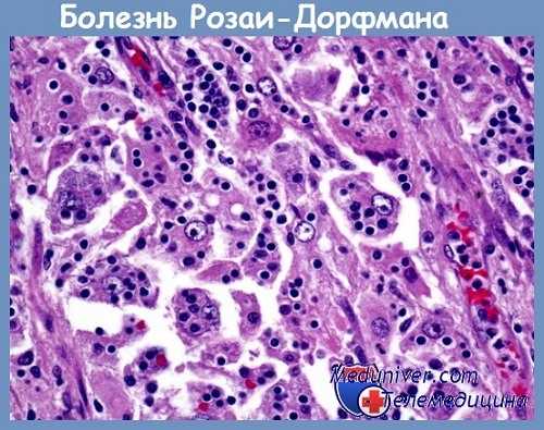 Болезнь Розаи-Дорфмана