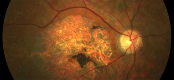 Ювенильная макулярная дегенерация