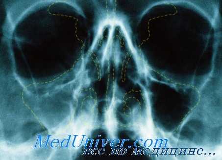 гайморовы пазухи носа