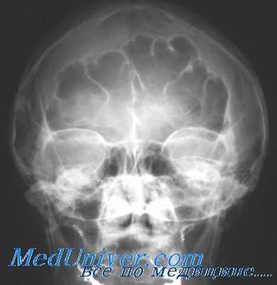 рентгенография решетчатых пазух носа