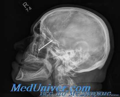 повреждения глазницы на рентгенограмме