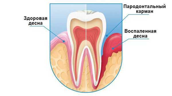 Воспаление дёсен