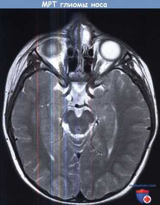 МРТ глиомы носа