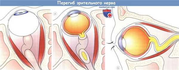 Перегиб зрительного нерва