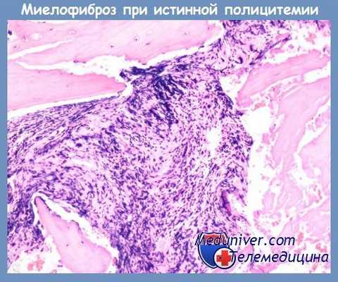 миелофиброз при истинной полицитемии