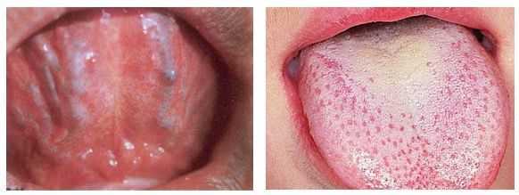 Симптомы глоссалгии