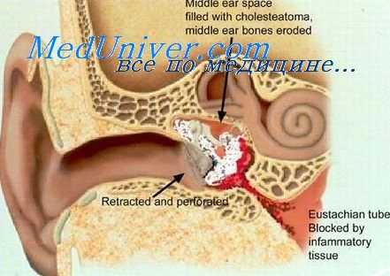 евстахиева труба