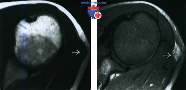 Глубокая доброкачественная фиброзная гистиоцитома - лучевая диагностика