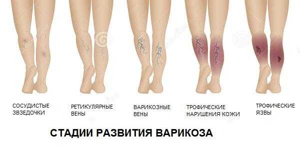 Стадии варикоза вен нижних конечностей
