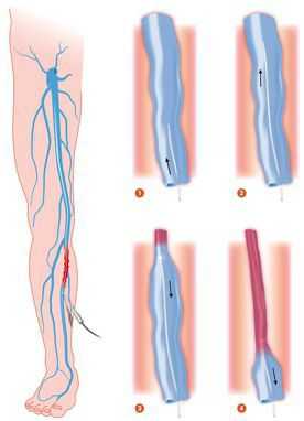 Эндовазальная лазерная коагуляция