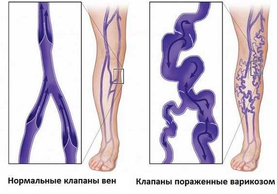 Венозные клапаны