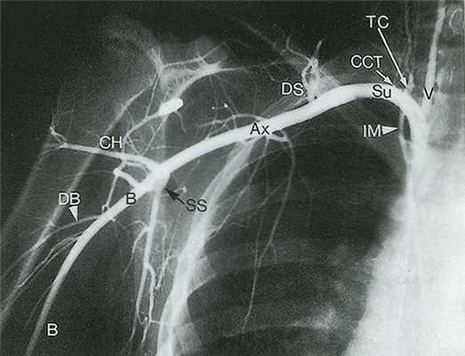 Рис. 14.3. Подключичная артерия (Su) отходит от подмышечной артерии (Ах)