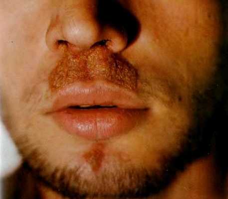 трихофития с гнойниками