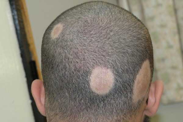очаговое облысение из-за микоза