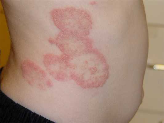 грибковое поражение кожи