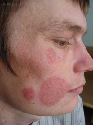 трихофития на лице