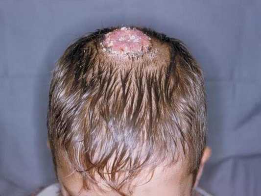 рубцы на коже волосистой части головы при глубокой трихофитии