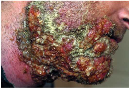 нагноение при трихофитии