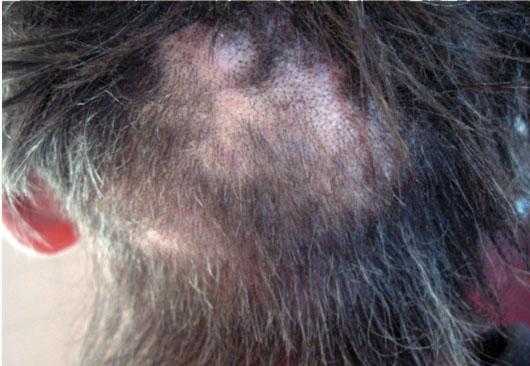 Многочисленные очаги поредения волос при трихофитии