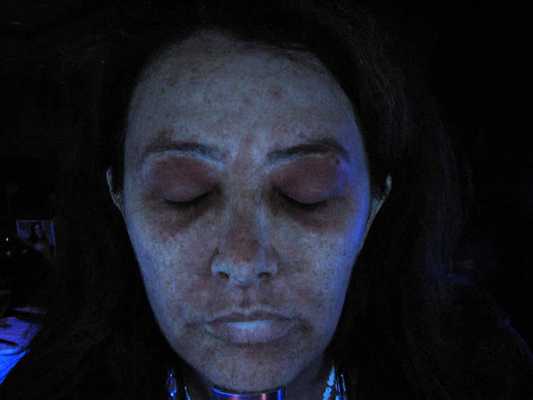 трихофития под лампой Вуда